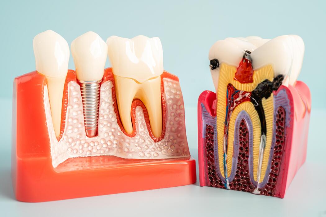Teeth Filling