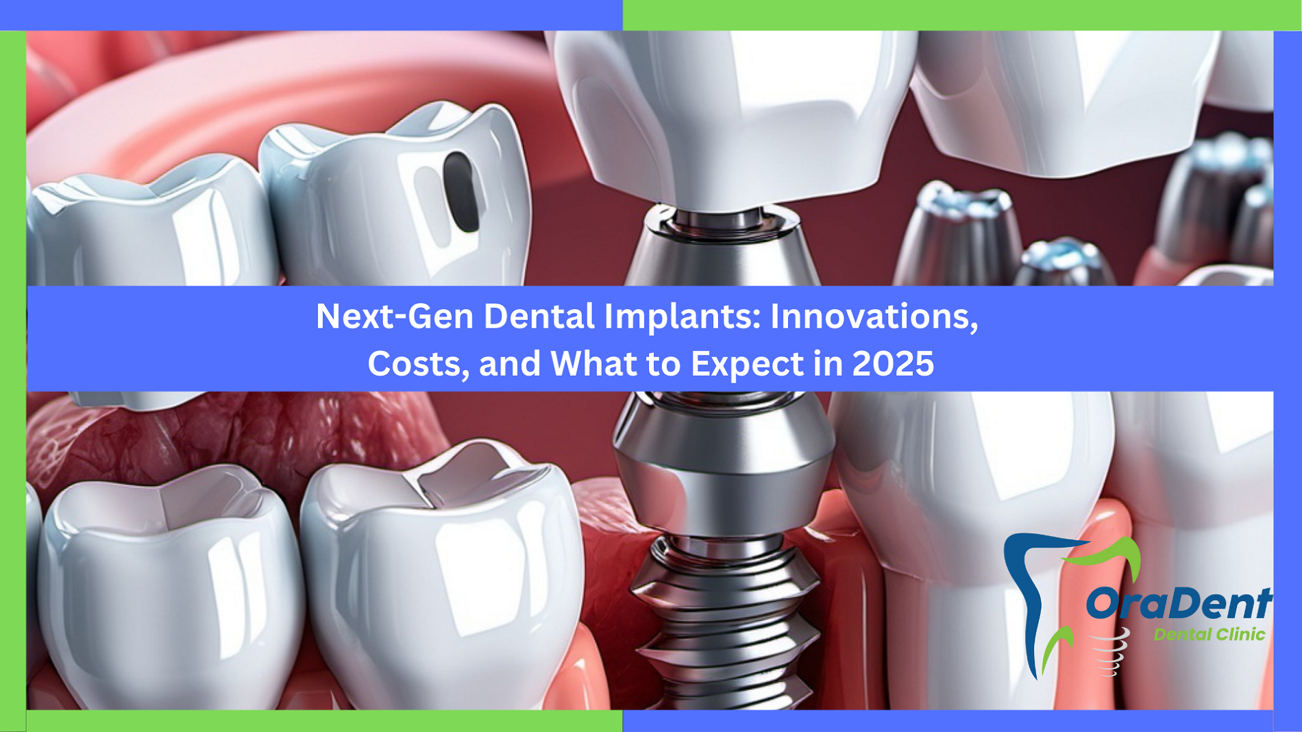 Next-Gen Dental Implants: Innovations, Costs, and What to Expect in 2025